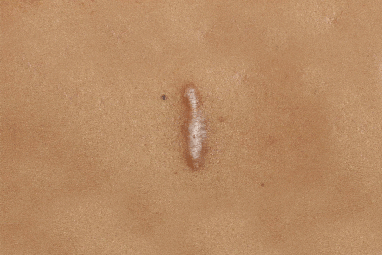 tratamento para queloide