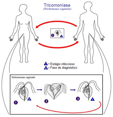 tricomoníase o que é