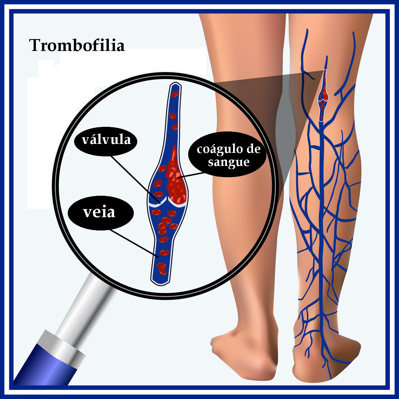 erros comuns no diagnóstico de trombofilia